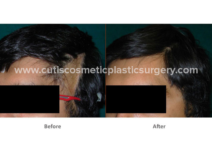 Successful Hair Transplant on Scarred Area of The Scalp | Cutis Hospital