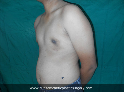Male Breast Reduction Before/After – Cutis Hospital Ahmedabad
