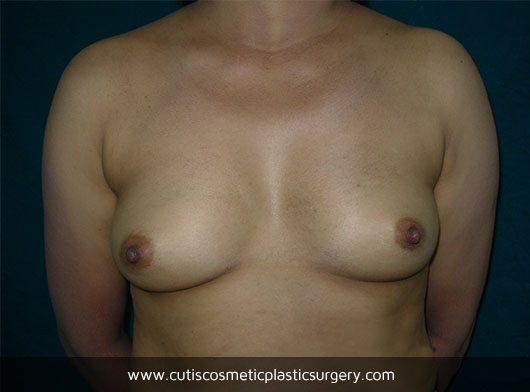 Breast Augmentation Surgery in Ahmedabad – Before/After – Cutis Hospital