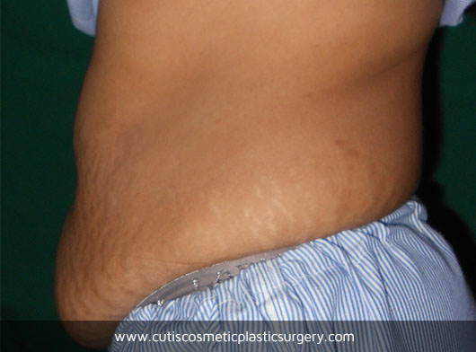 Abdominoplasty Before/After Photos – Cutis Hospital Ahmedabad