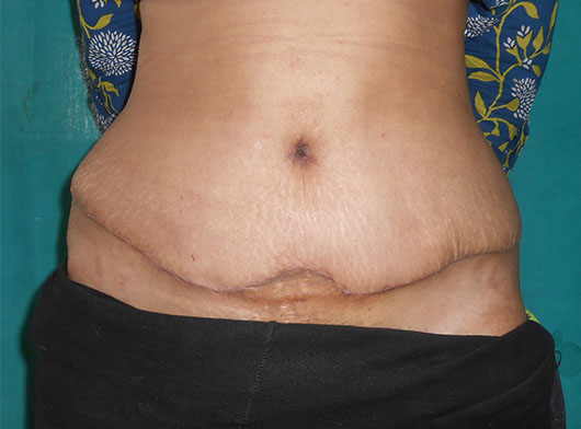 Tummy Tuck Before/After Photos – Cutis Hospital Ahmedabad