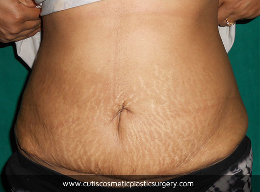 Abdominoplasty Before/After Photos