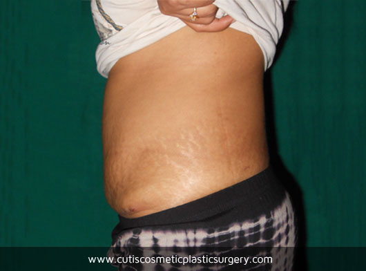Abdominoplasty Before/After Photos – Cutis Hospital Ahmedabad