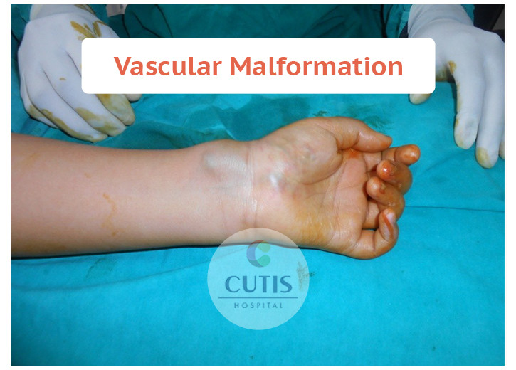 Vascular malformation of hand treatment in ahmedabad
