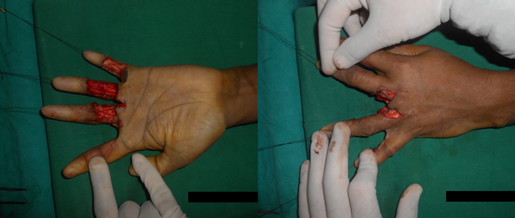 burn hand deformity surgery Ahmedabad