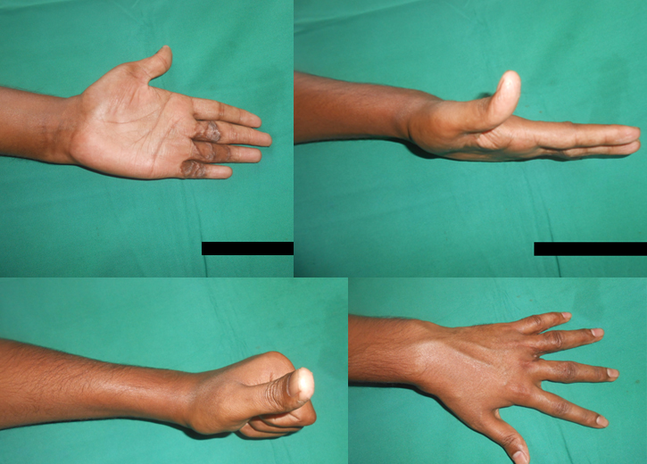post burn hand deformity treatment Ahmedabad
