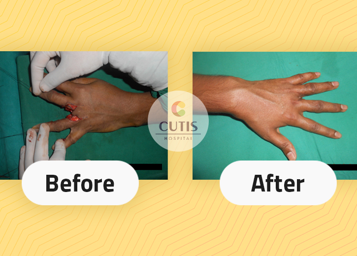 Post burn hand deformity treatment before/after